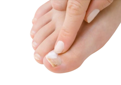 How Effective Is Hydrogen Peroxide For Toenail Fungus?